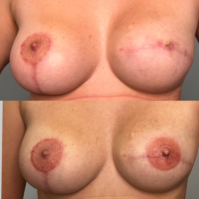 Imitation of areola after mastoctomy with the help of permanent tattooing. - NSFW, My, Areola, Mammoplasty, Novokuznetsk